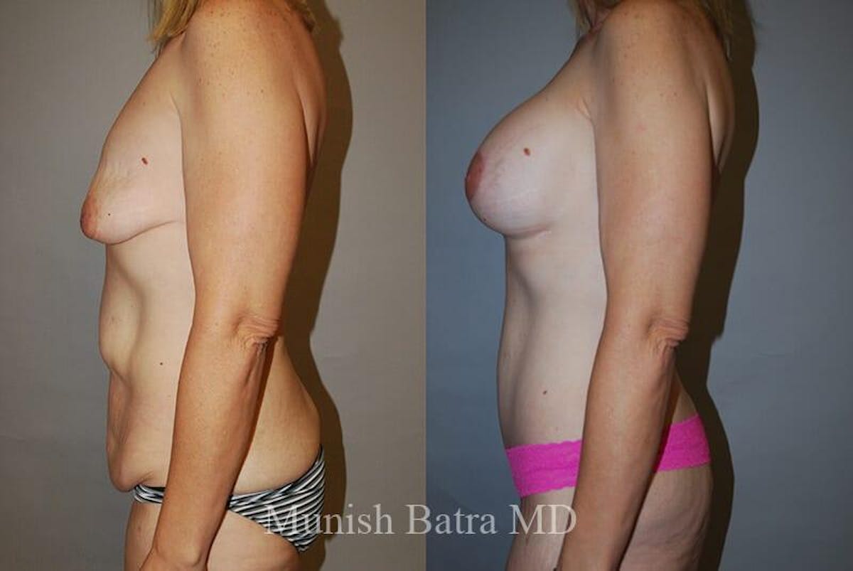 GBRX Abdominoplasty Reconstruction Before & After Gallery - Patient 255026 - Image 2