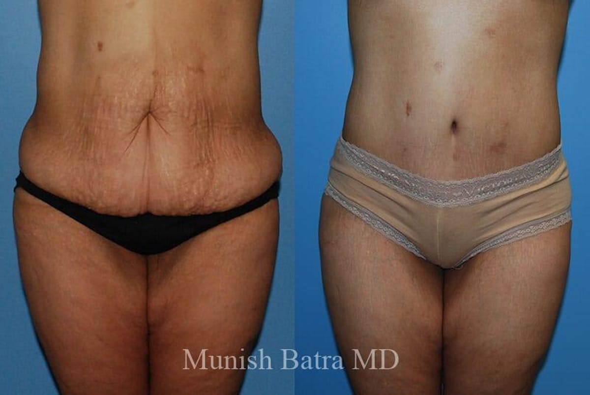 GBRX Abdominoplasty Reconstruction Before & After Gallery - Patient 209873 - Image 1