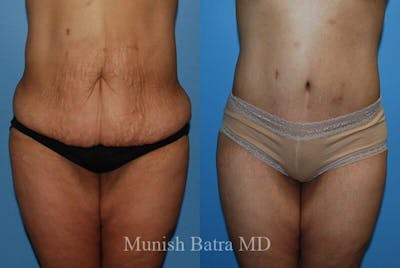 GBRX Abdominoplasty Reconstruction Before & After Gallery - Patient 209873 - Image 1