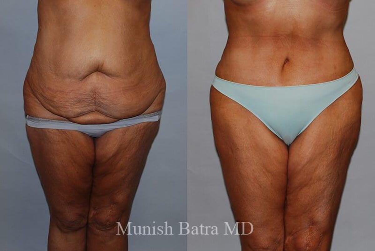 GBRX Abdominoplasty Reconstruction Before & After Gallery - Patient 282497 - Image 1