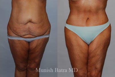 GBRX Abdominoplasty Reconstruction Before & After Gallery - Patient 282497 - Image 1