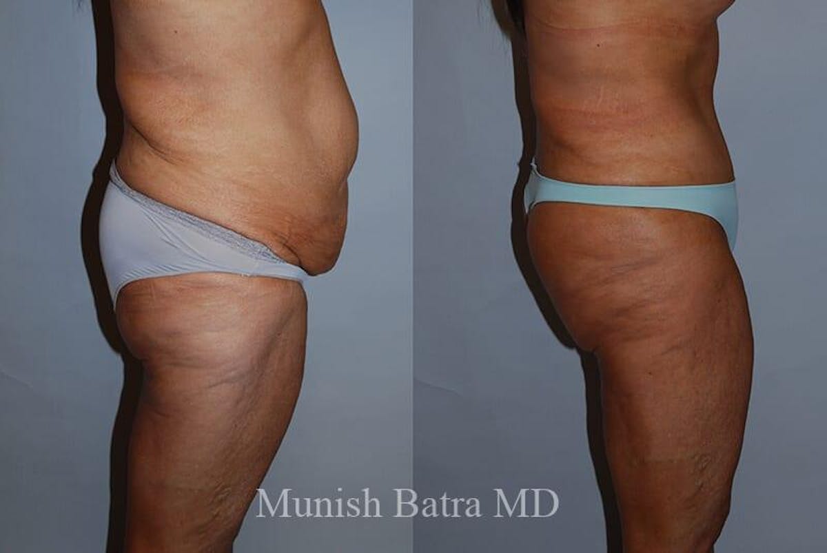 GBRX Abdominoplasty Reconstruction Before & After Gallery - Patient 282497 - Image 2