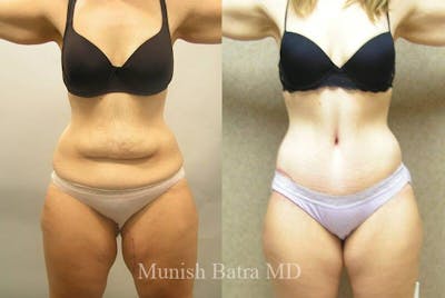 GBRX Abdominoplasty Reconstruction Before & After Gallery - Patient 221224 - Image 1