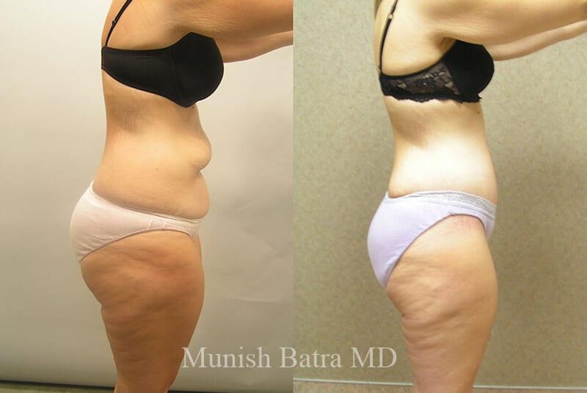 GBRX Abdominoplasty Reconstruction Before & After Gallery - Patient 221224 - Image 2