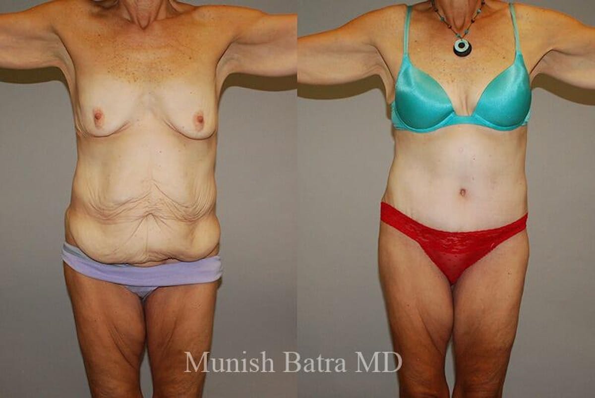 GBRX Abdominoplasty Reconstruction Before & After Gallery - Patient 384850 - Image 1