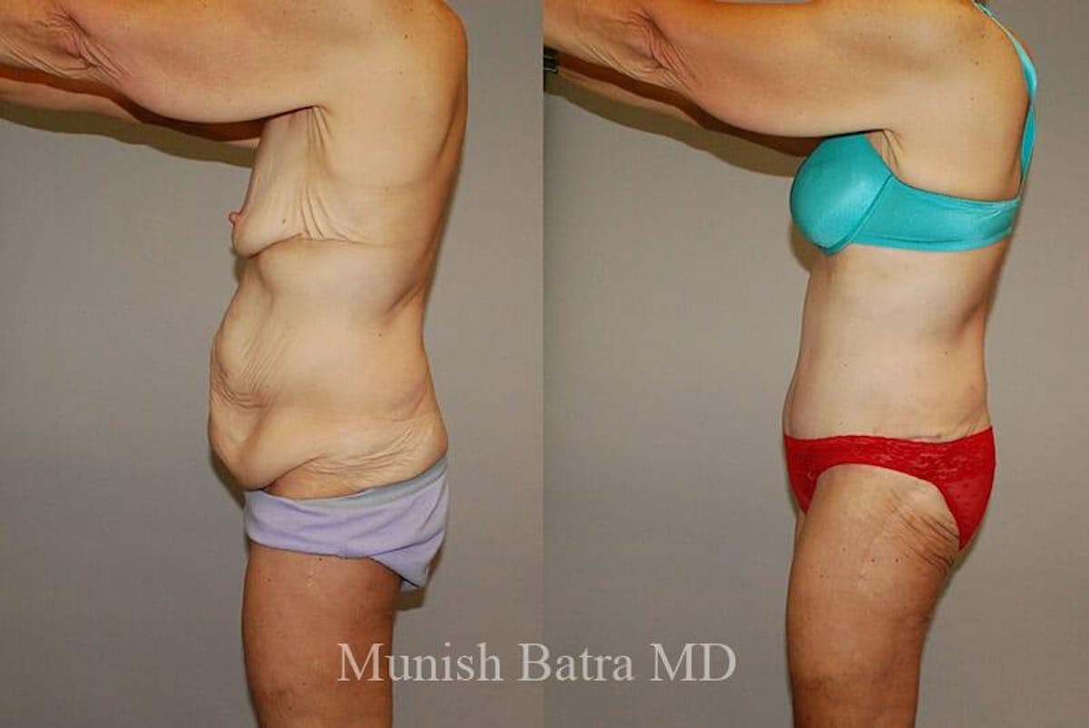 GBRX Abdominoplasty Reconstruction Before & After Gallery - Patient 384850 - Image 2