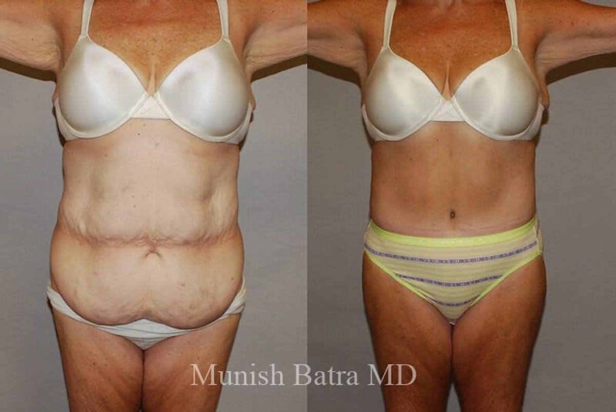 GBRX Abdominoplasty Reconstruction Before & After Gallery - Patient 385289 - Image 1