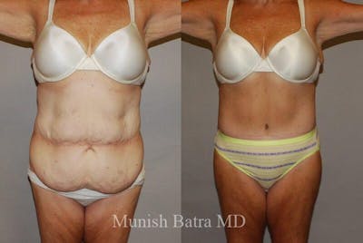 GBRX Abdominoplasty Reconstruction Before & After Gallery - Patient 385289 - Image 1