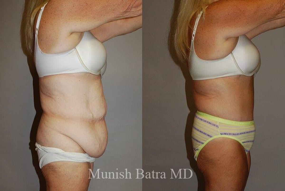 GBRX Abdominoplasty Reconstruction Before & After Gallery - Patient 385289 - Image 2