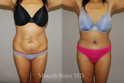 GBRX Abdominoplasty Reconstruction Before & After Gallery - Patient 105767 - Image 1