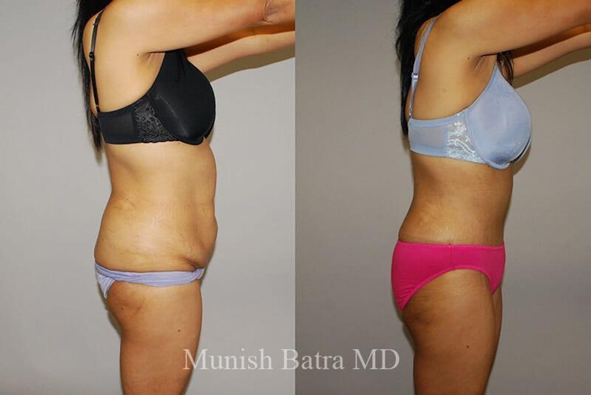 GBRX Abdominoplasty Reconstruction Before & After Gallery - Patient 105767 - Image 2