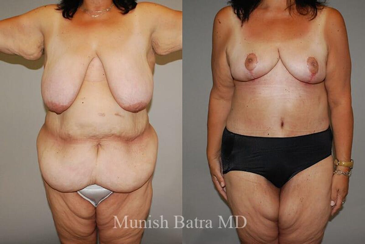 GBRX Abdominoplasty Reconstruction Before & After Gallery - Patient 352691 - Image 1