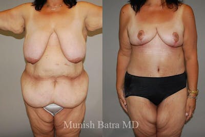 GBRX Abdominoplasty Reconstruction Before & After Gallery - Patient 352691 - Image 1