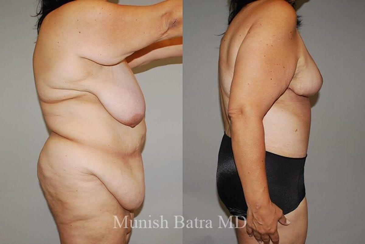 GBRX Abdominoplasty Reconstruction Before & After Gallery - Patient 352691 - Image 2