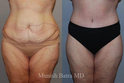 GBRX Abdominoplasty Reconstruction Before & After Gallery - Patient 349901 - Image 1