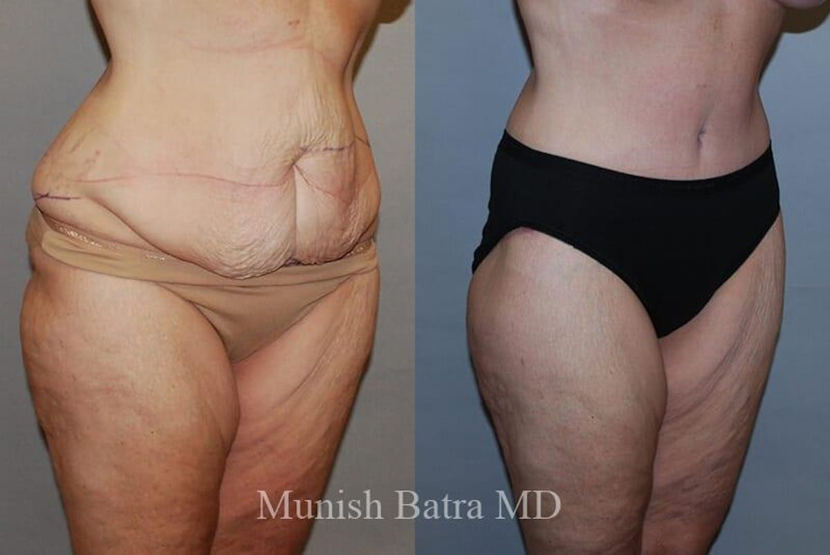 GBRX Abdominoplasty Reconstruction Before & After Gallery - Patient 349901 - Image 2