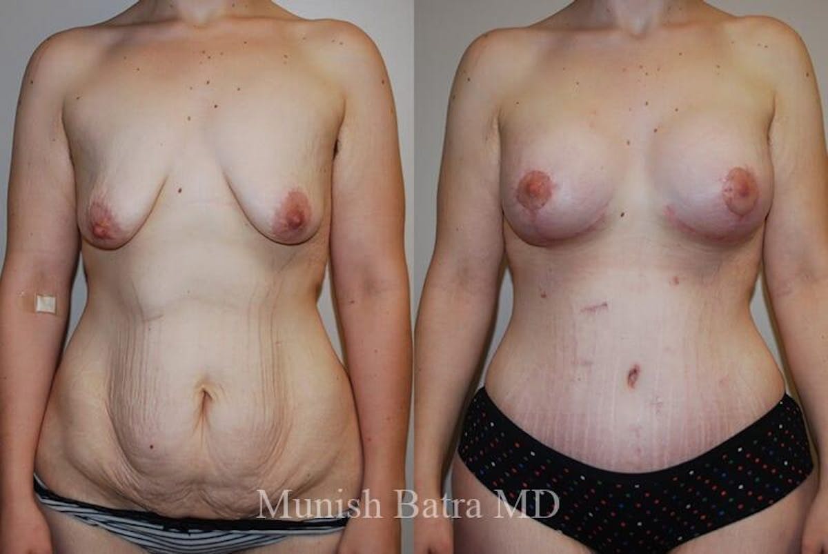 GBRX Abdominoplasty Reconstruction Before & After Gallery - Patient 335106 - Image 1