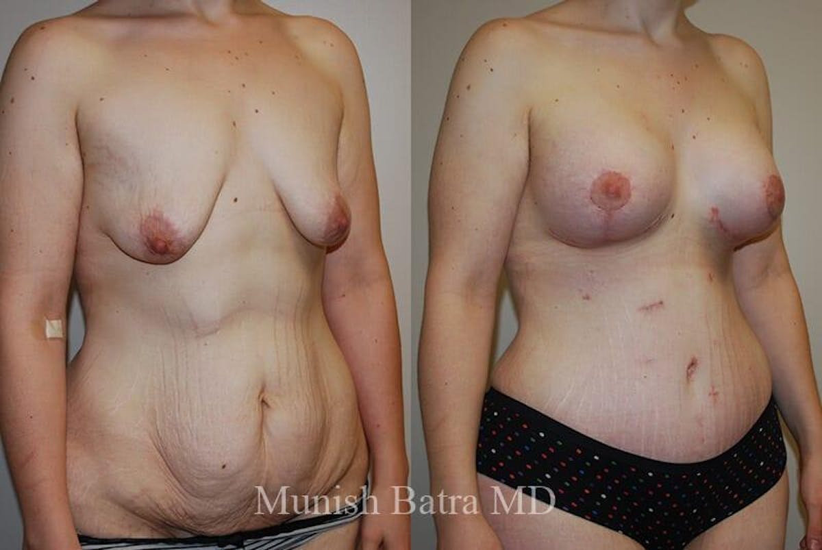 GBRX Abdominoplasty Reconstruction Before & After Gallery - Patient 335106 - Image 2