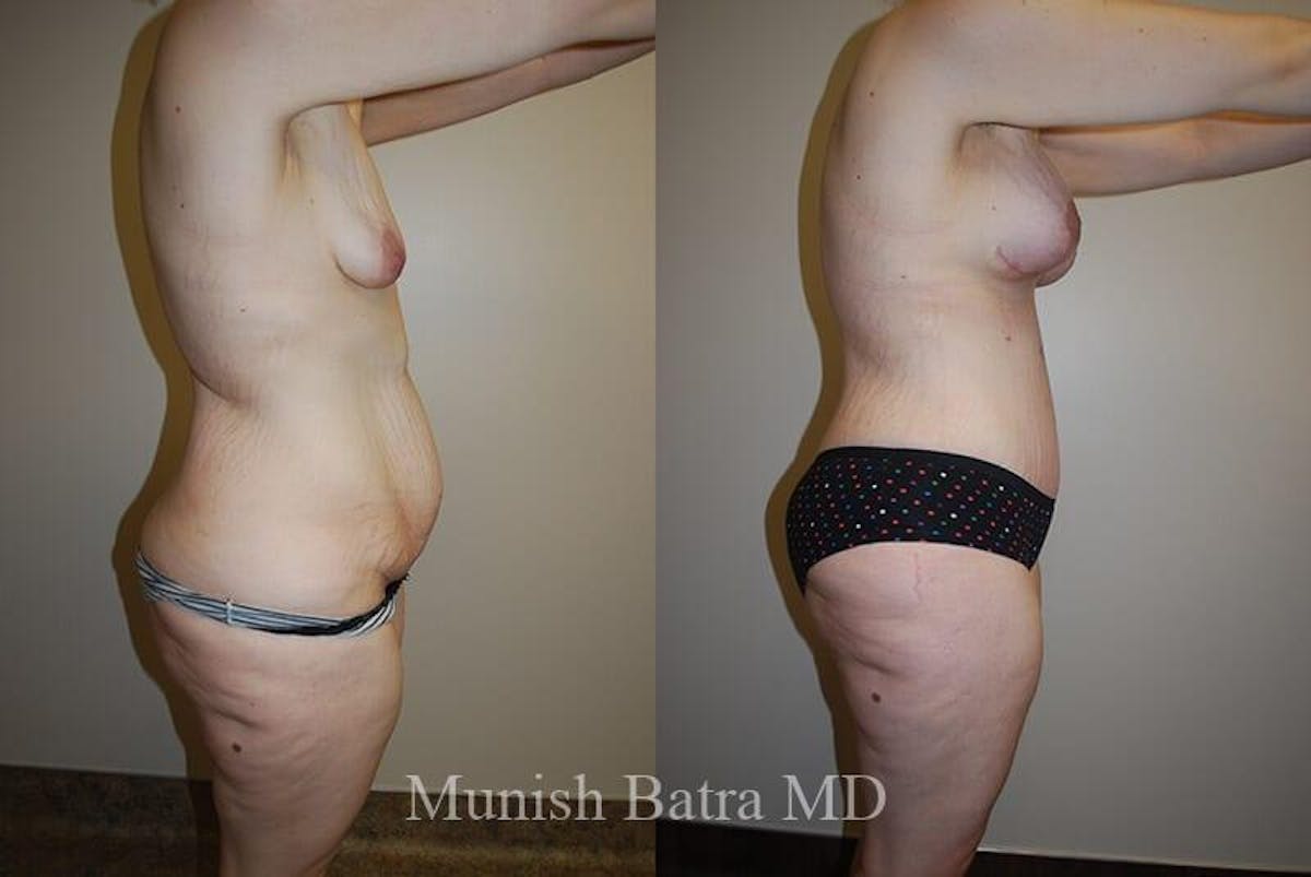 GBRX Abdominoplasty Reconstruction Before & After Gallery - Patient 335106 - Image 3