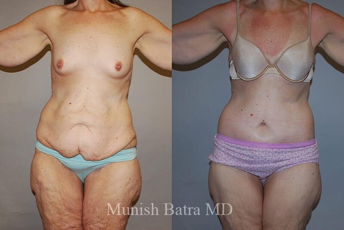 GBRX Abdominoplasty Reconstruction Before & After Gallery - Patient 298340 - Image 1