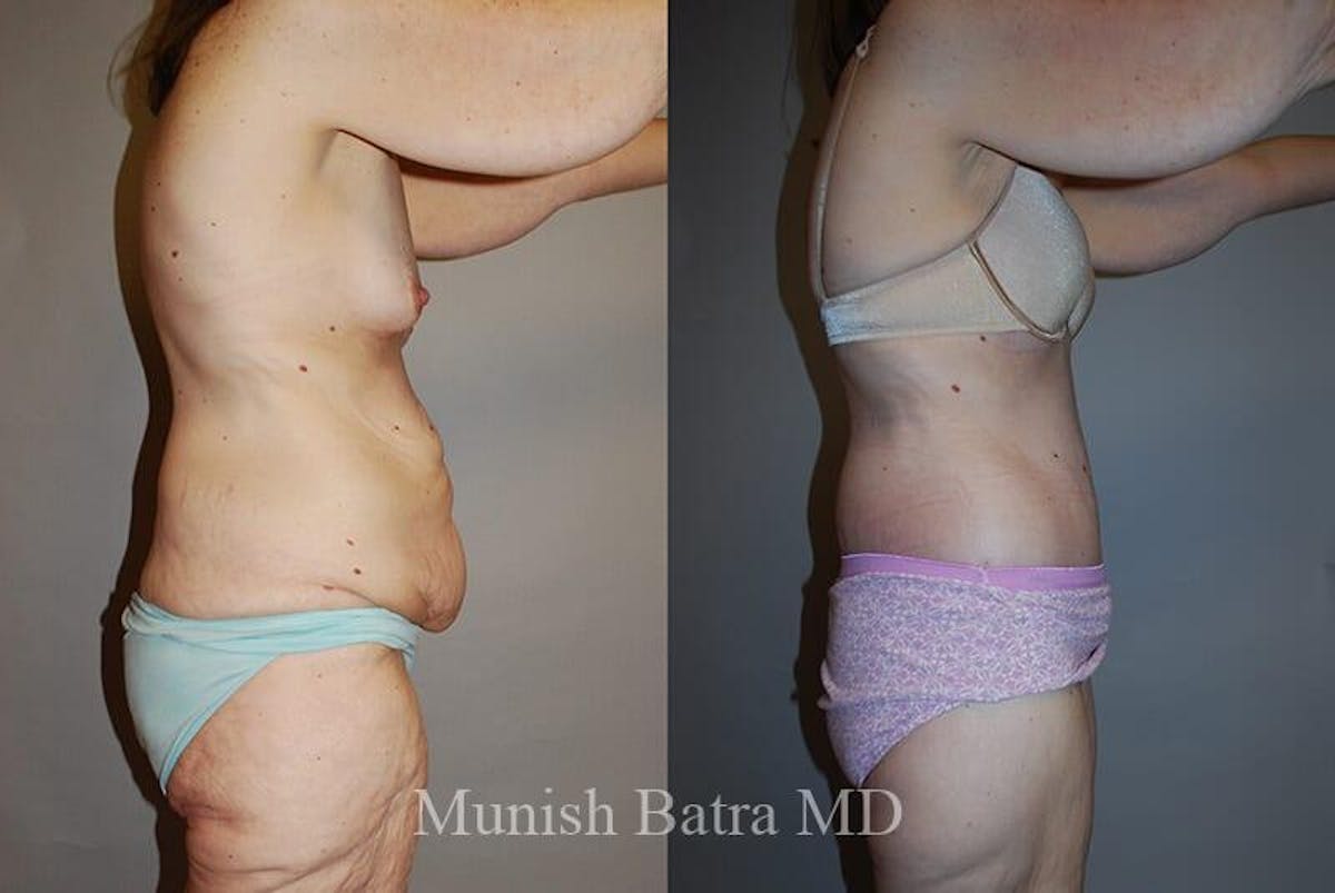 GBRX Abdominoplasty Reconstruction Before & After Gallery - Patient 298340 - Image 2