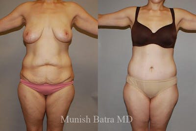 GBRX Abdominoplasty Reconstruction Before & After Gallery - Patient 399652 - Image 1