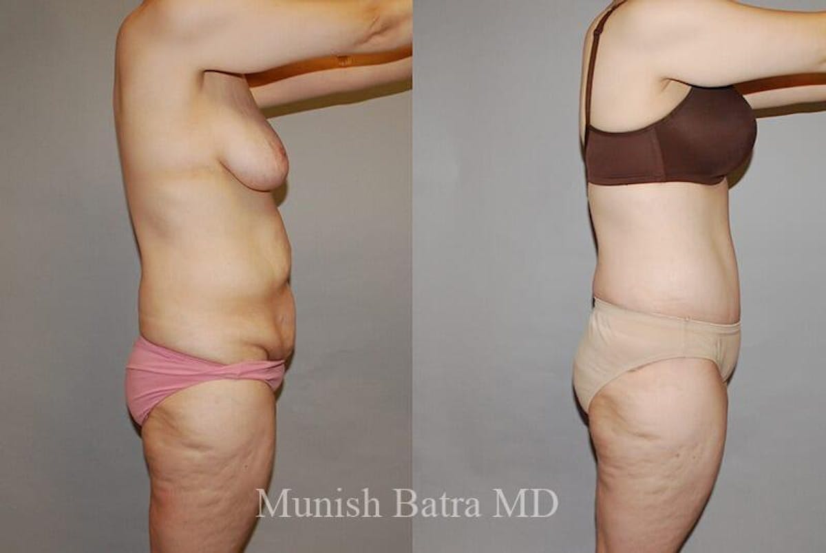 GBRX Abdominoplasty Reconstruction Before & After Gallery - Patient 399652 - Image 2