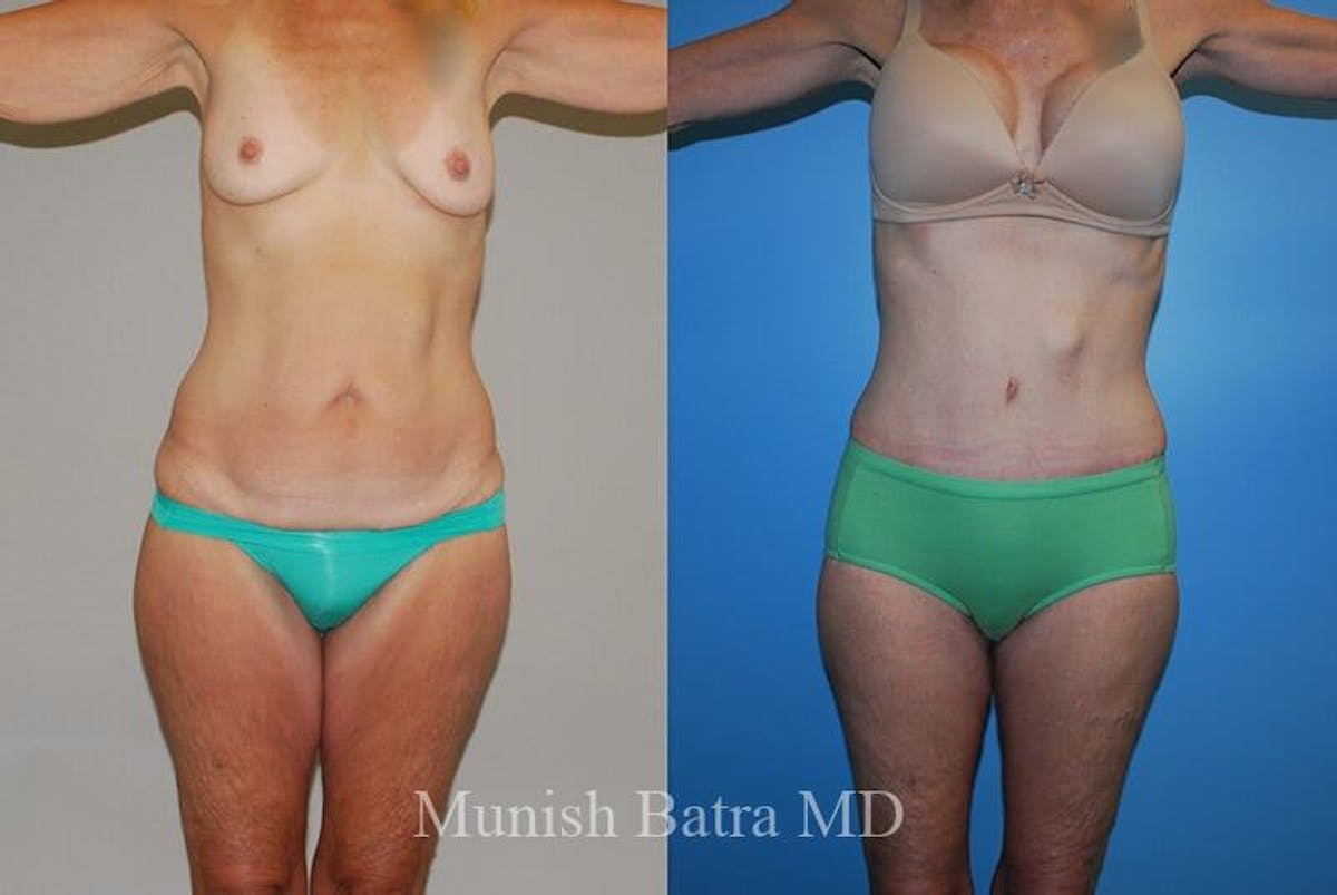 GBRX Abdominoplasty Reconstruction Before & After Gallery - Patient 783100 - Image 1