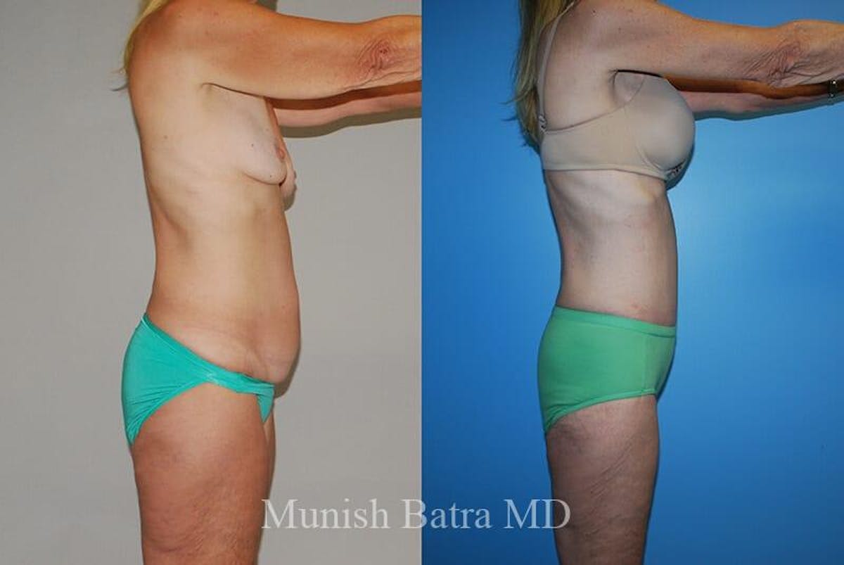 GBRX Abdominoplasty Reconstruction Before & After Gallery - Patient 783100 - Image 2