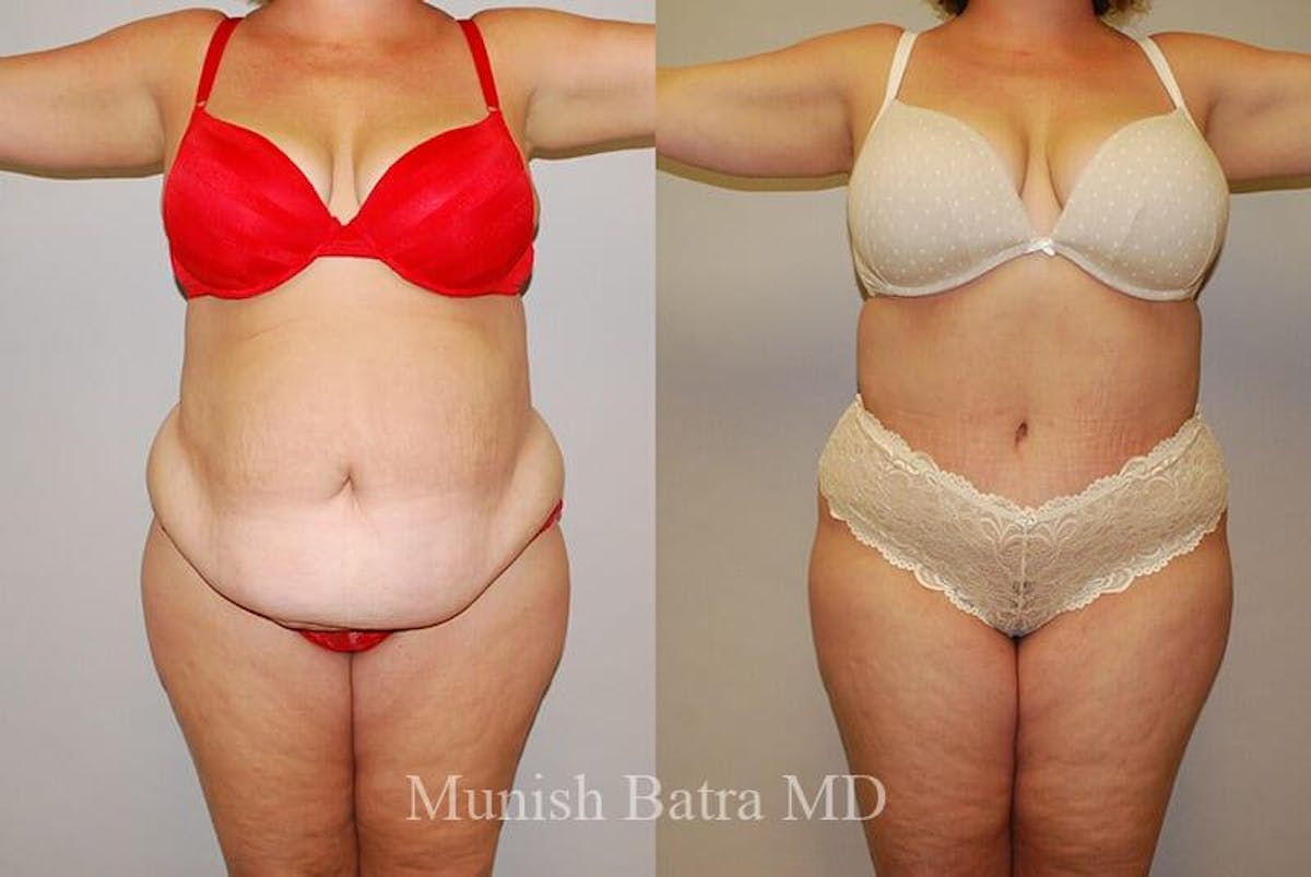 GBRX Abdominoplasty Reconstruction Before & After Gallery - Patient 277954 - Image 1
