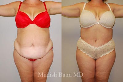 GBRX Abdominoplasty Reconstruction Before & After Gallery - Patient 277954 - Image 1