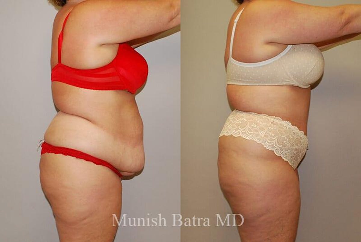 GBRX Abdominoplasty Reconstruction Before & After Gallery - Patient 277954 - Image 2