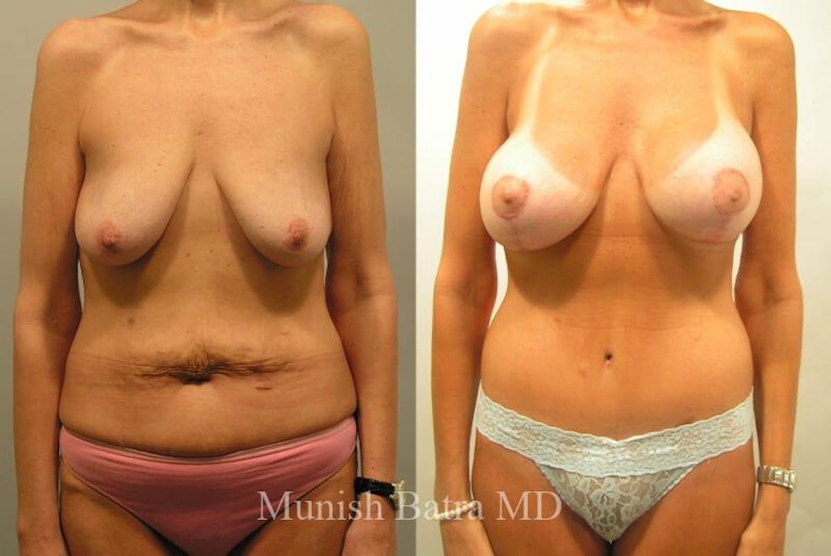 GBRX Abdominoplasty Reconstruction Before & After Gallery - Patient 129171 - Image 1