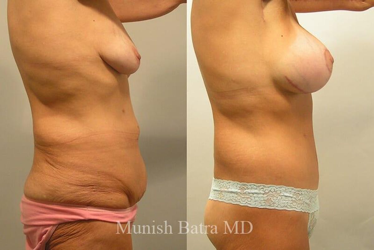 GBRX Abdominoplasty Reconstruction Before & After Gallery - Patient 129171 - Image 2