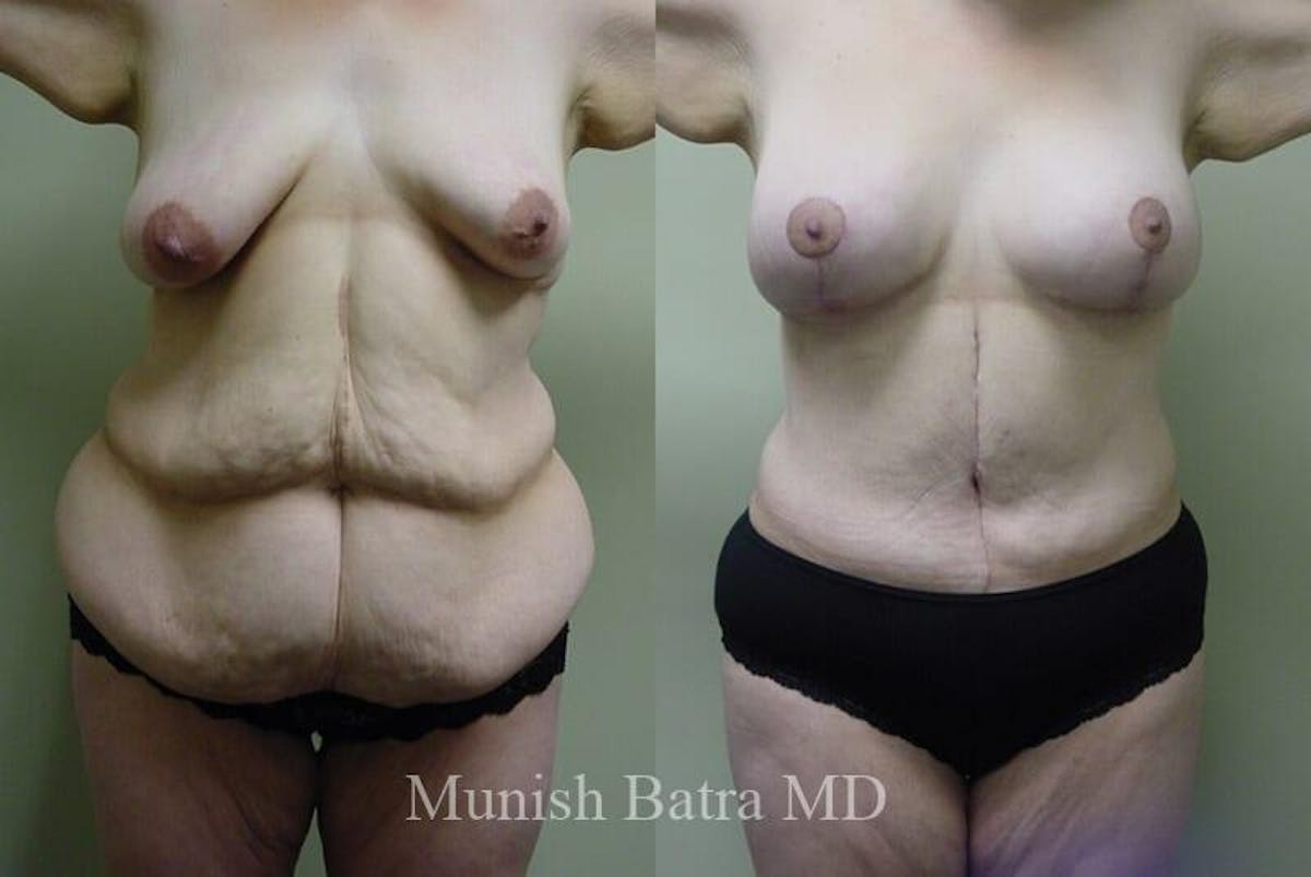 GBRX Abdominoplasty Reconstruction Before & After Gallery - Patient 136775 - Image 1