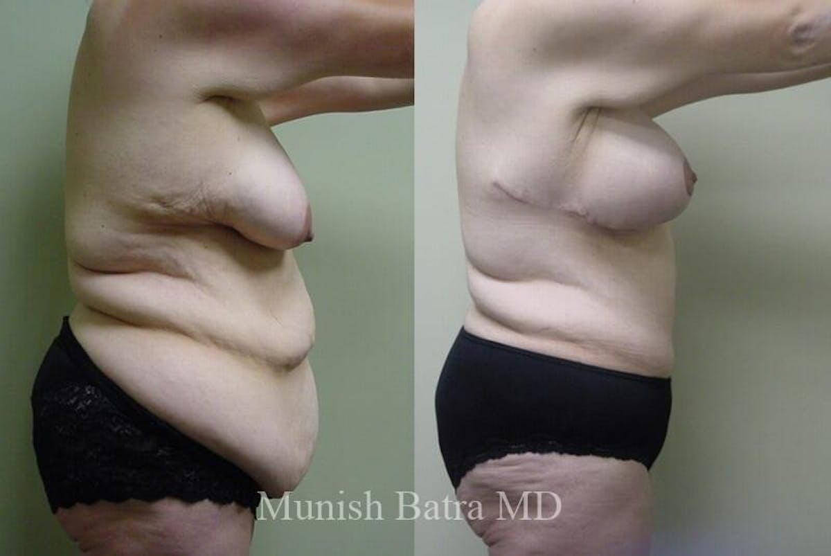 GBRX Abdominoplasty Reconstruction Before & After Gallery - Patient 136775 - Image 2