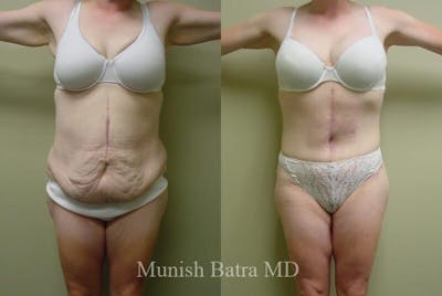 GBRX Abdominoplasty Reconstruction Before & After Gallery - Patient 386317 - Image 1