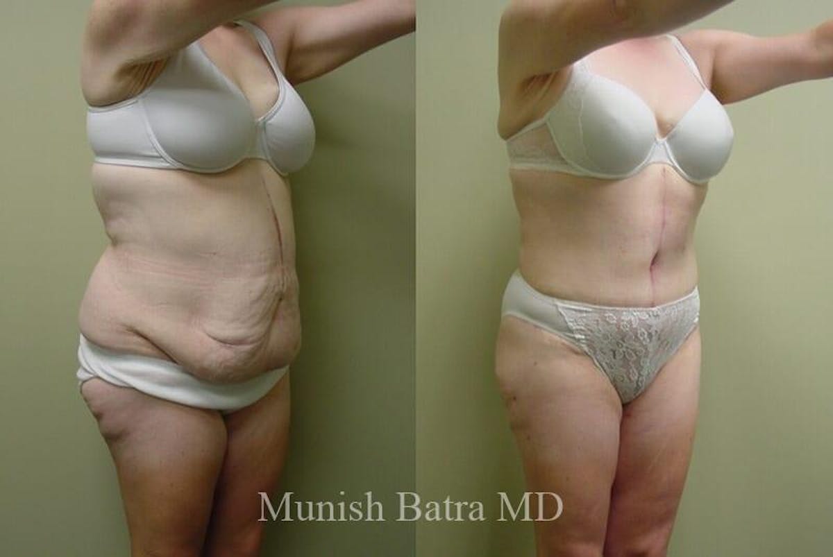 GBRX Abdominoplasty Reconstruction Before & After Gallery - Patient 386317 - Image 2