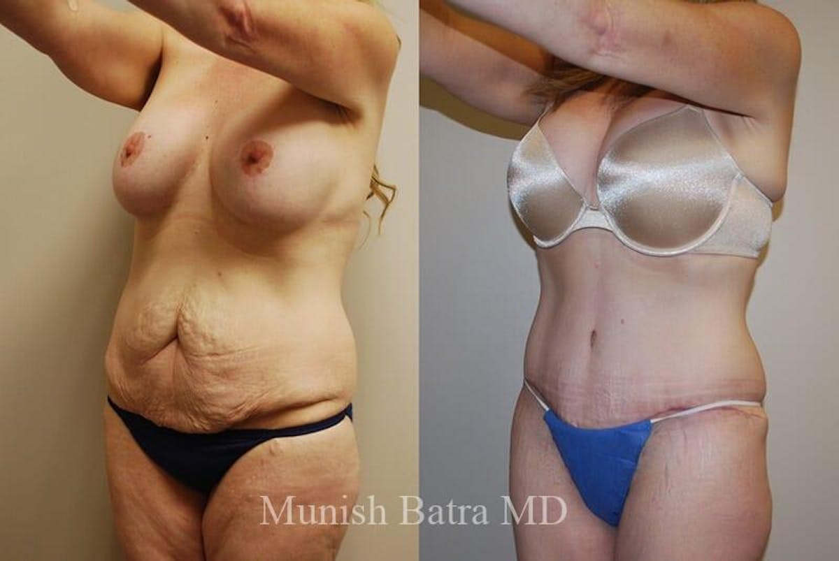 GBRX Abdominoplasty Reconstruction Before & After Gallery - Patient 186984 - Image 1