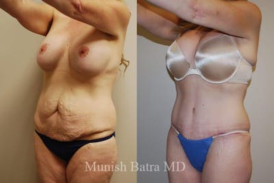 GBRX Abdominoplasty Reconstruction Before & After Gallery - Patient 186984 - Image 1