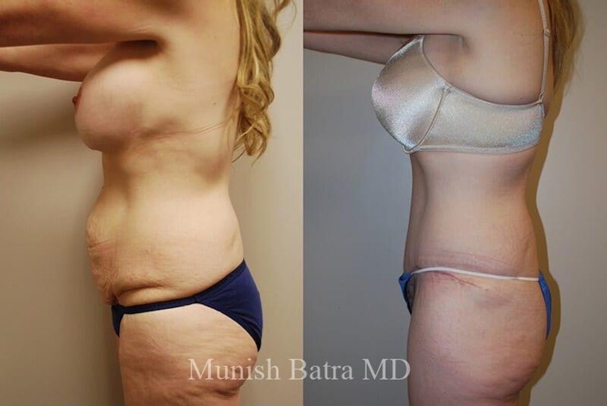 GBRX Abdominoplasty Reconstruction Before & After Gallery - Patient 186984 - Image 2