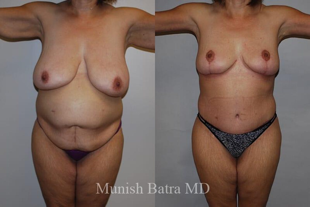 GBRX Abdominoplasty Reconstruction Before & After Gallery - Patient 291677 - Image 1