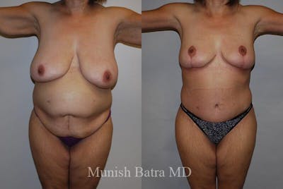 GBRX Abdominoplasty Reconstruction Before & After Gallery - Patient 291677 - Image 1