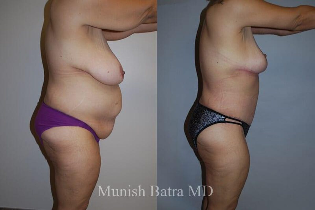 GBRX Abdominoplasty Reconstruction Before & After Gallery - Patient 291677 - Image 2