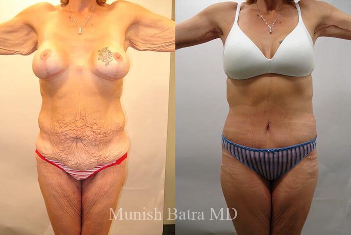 GBRX Abdominoplasty Reconstruction Before & After Gallery - Patient 156534 - Image 1