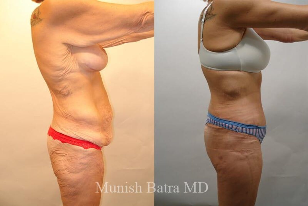 GBRX Abdominoplasty Reconstruction Before & After Gallery - Patient 156534 - Image 2
