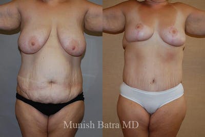GBRX Abdominoplasty Reconstruction Before & After Gallery - Patient 281153 - Image 1