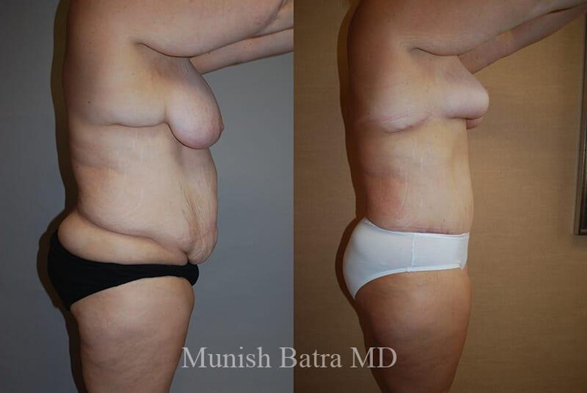 GBRX Abdominoplasty Reconstruction Before & After Gallery - Patient 281153 - Image 2