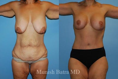 GBRX Abdominoplasty Reconstruction Before & After Gallery - Patient 293147 - Image 1