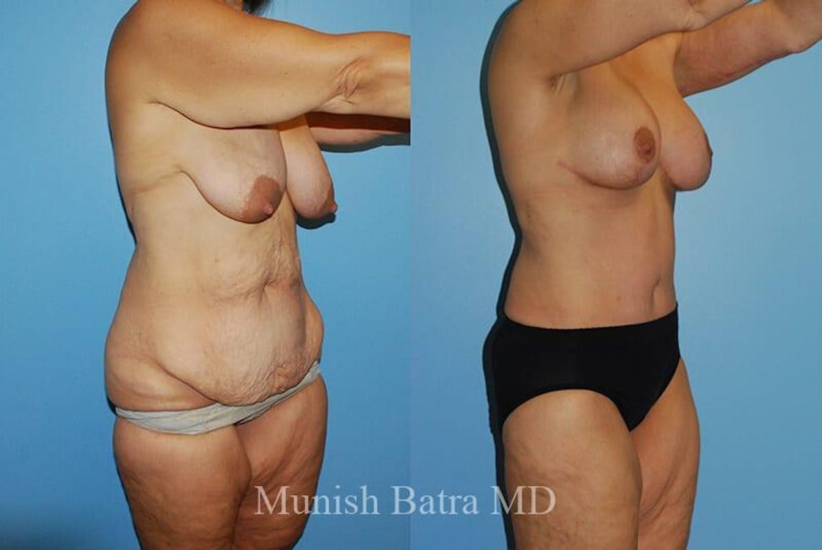 GBRX Abdominoplasty Reconstruction Before & After Gallery - Patient 293147 - Image 2